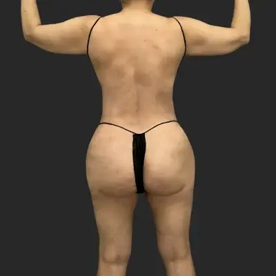 Tummy Tuck after at Be That Beautiful in Beverly Hills, CA