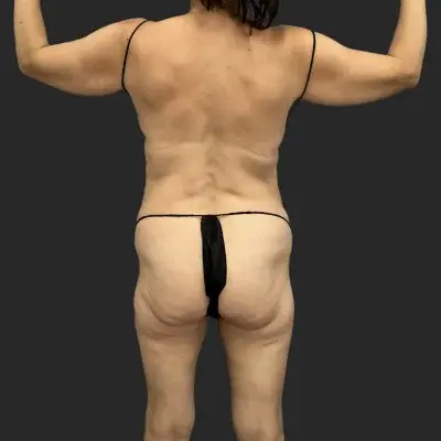 Tummy Tuck before at Be That Beautiful in Beverly Hills, CA