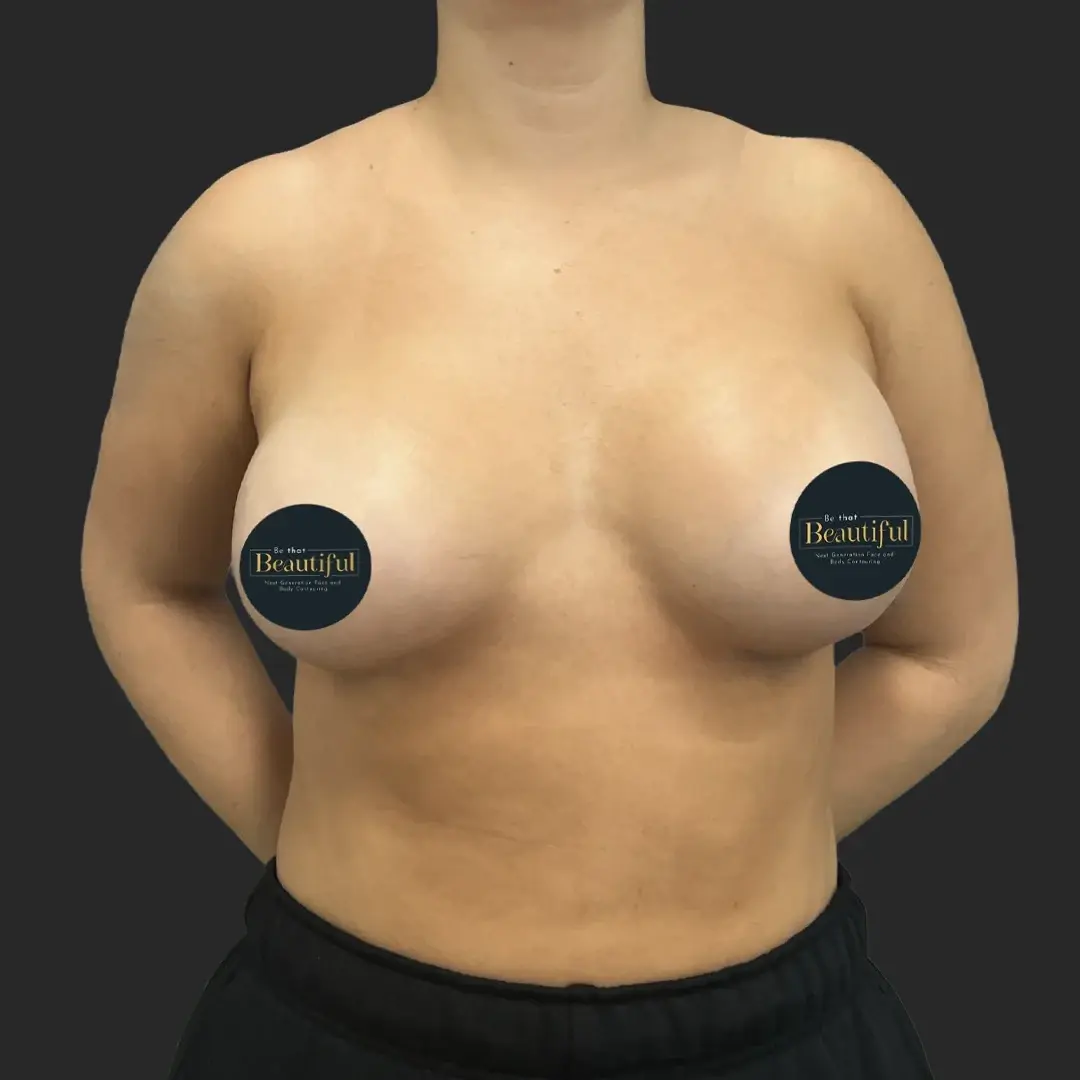 Be That Beautiful breast augmentation after — Beverly Hills, CA