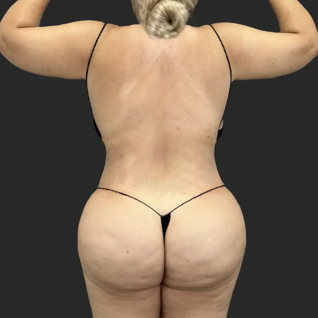 Be That Beautiful body contouring after — Beverly Hills, CA