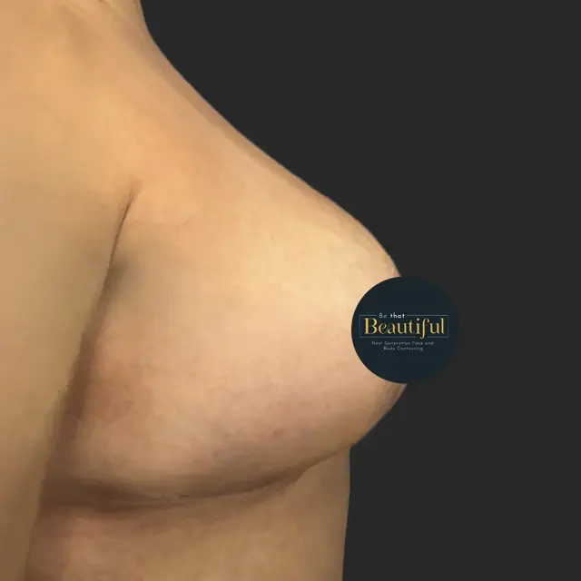 Breast Lift after at Be That Beautiful in Beverly Hills, CA