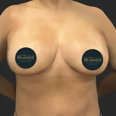 Be That Beautiful breast lift after — Beverly Hills, CA