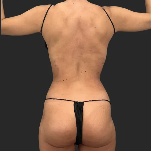 Thigh Lift after at Be That Beautiful in Beverly Hills, CA