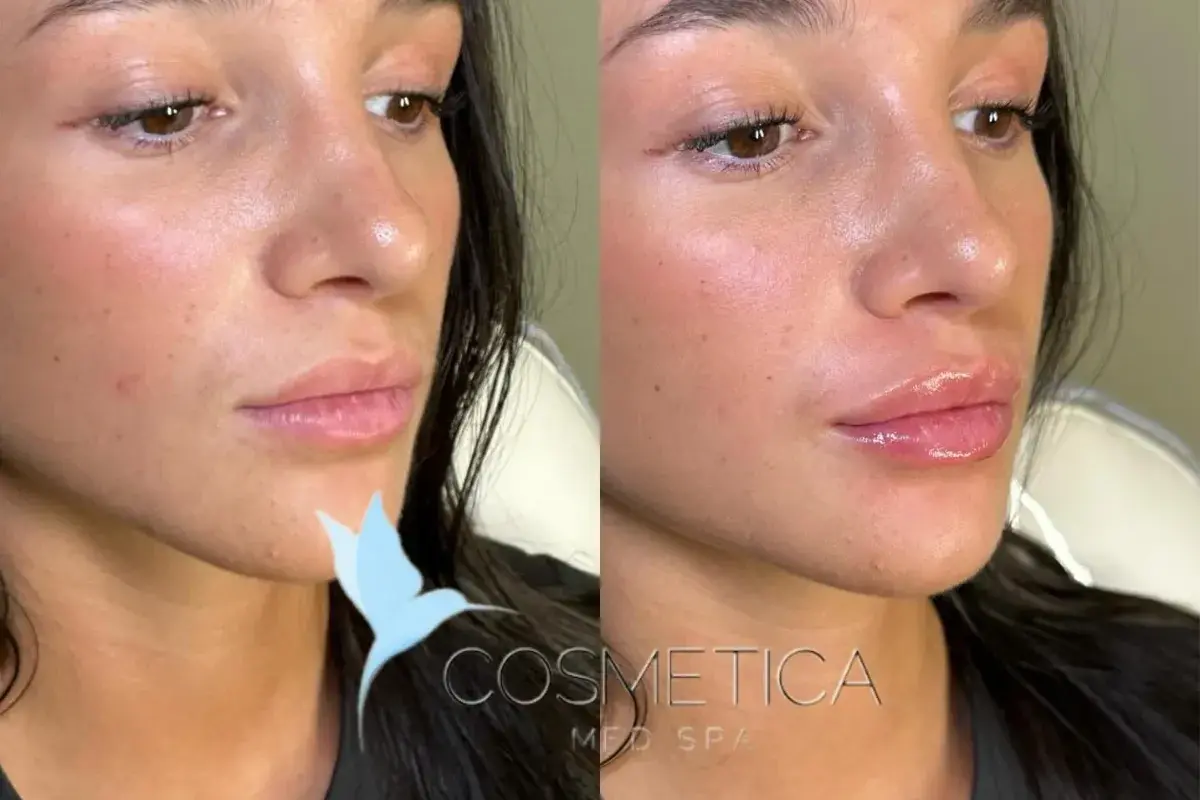 Cosmetica Med Spa lip filler result — Boca Raton, FL