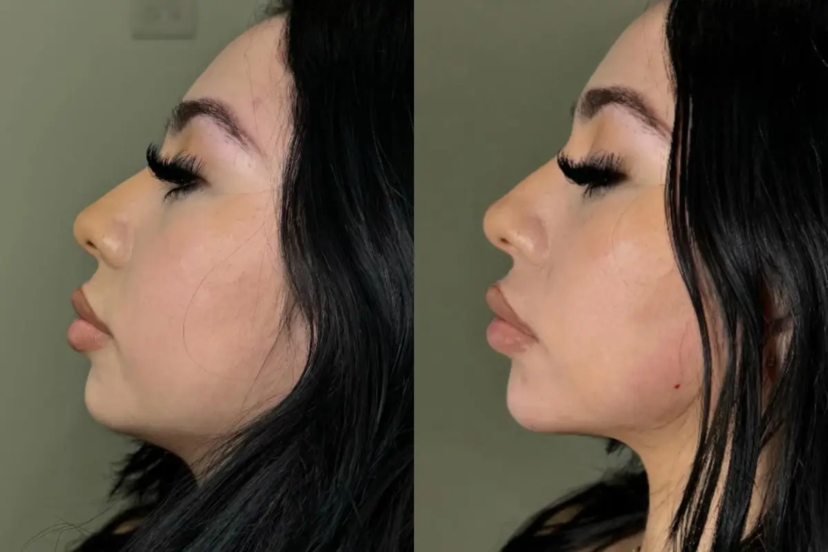 Cosmetica Med Spa jawline filler result — Boca Raton, FL