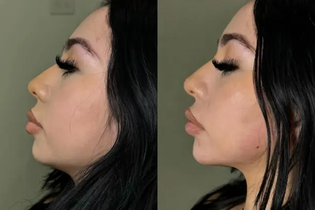 Jawline Filler result at Cosmetica Med Spa in Boca Raton, FL