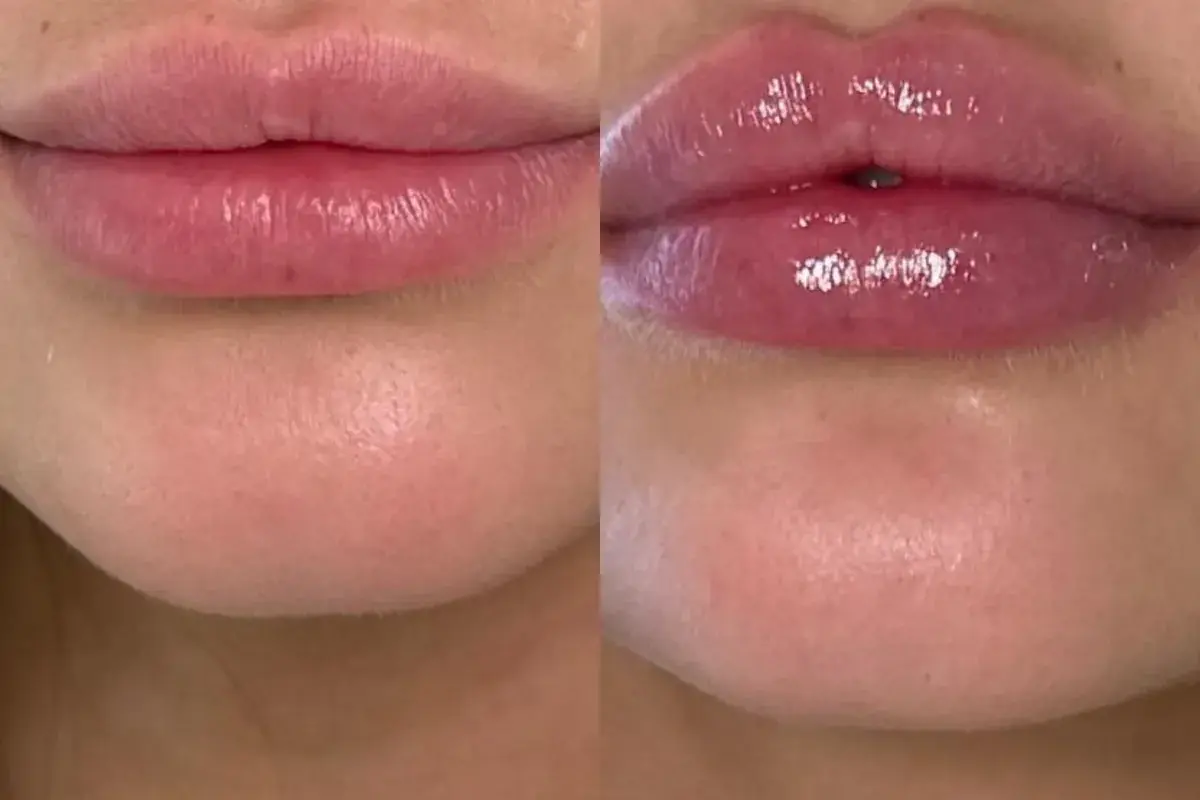 Cosmetica Med Spa lip filler result — Boca Raton, FL