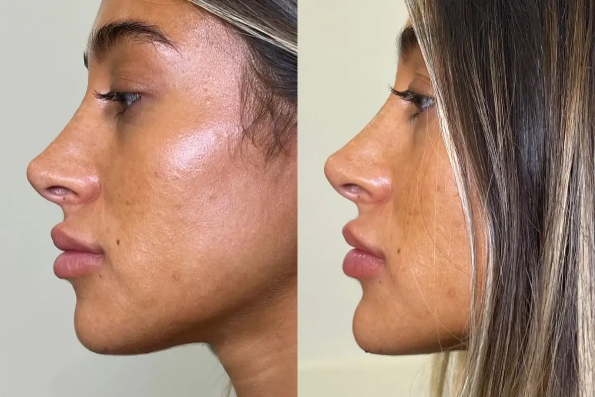 Cosmetica Med Spa jawline filler result — Boca Raton, FL
