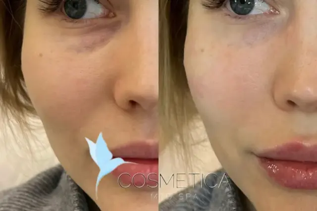 Juvederm result at Cosmetica Med Spa in Boca Raton, FL