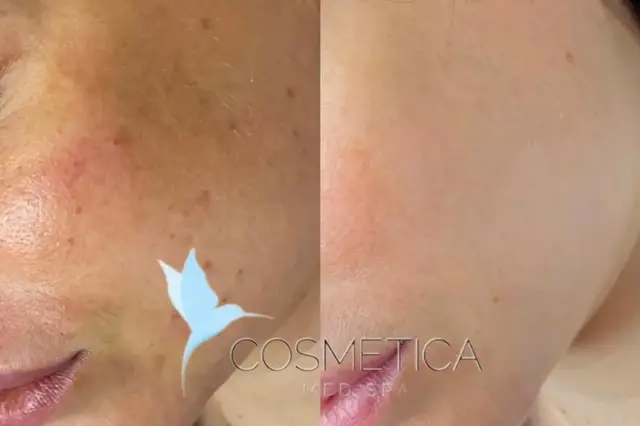 Microneedling result at Cosmetica Med Spa in Boca Raton, FL