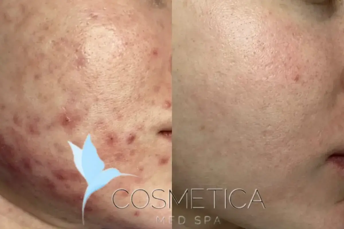 Cosmetica Med Spa microneedling result — Boca Raton, FL