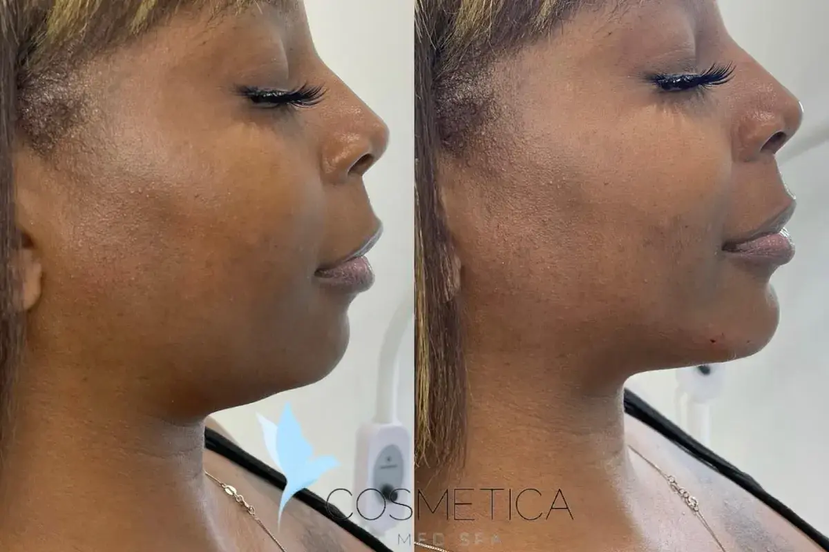Cosmetica Med Spa jawline filler result — Boca Raton, FL