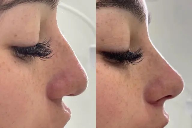 Liquid Rhinoplasty result at Cosmetica Med Spa in Boca Raton, FL