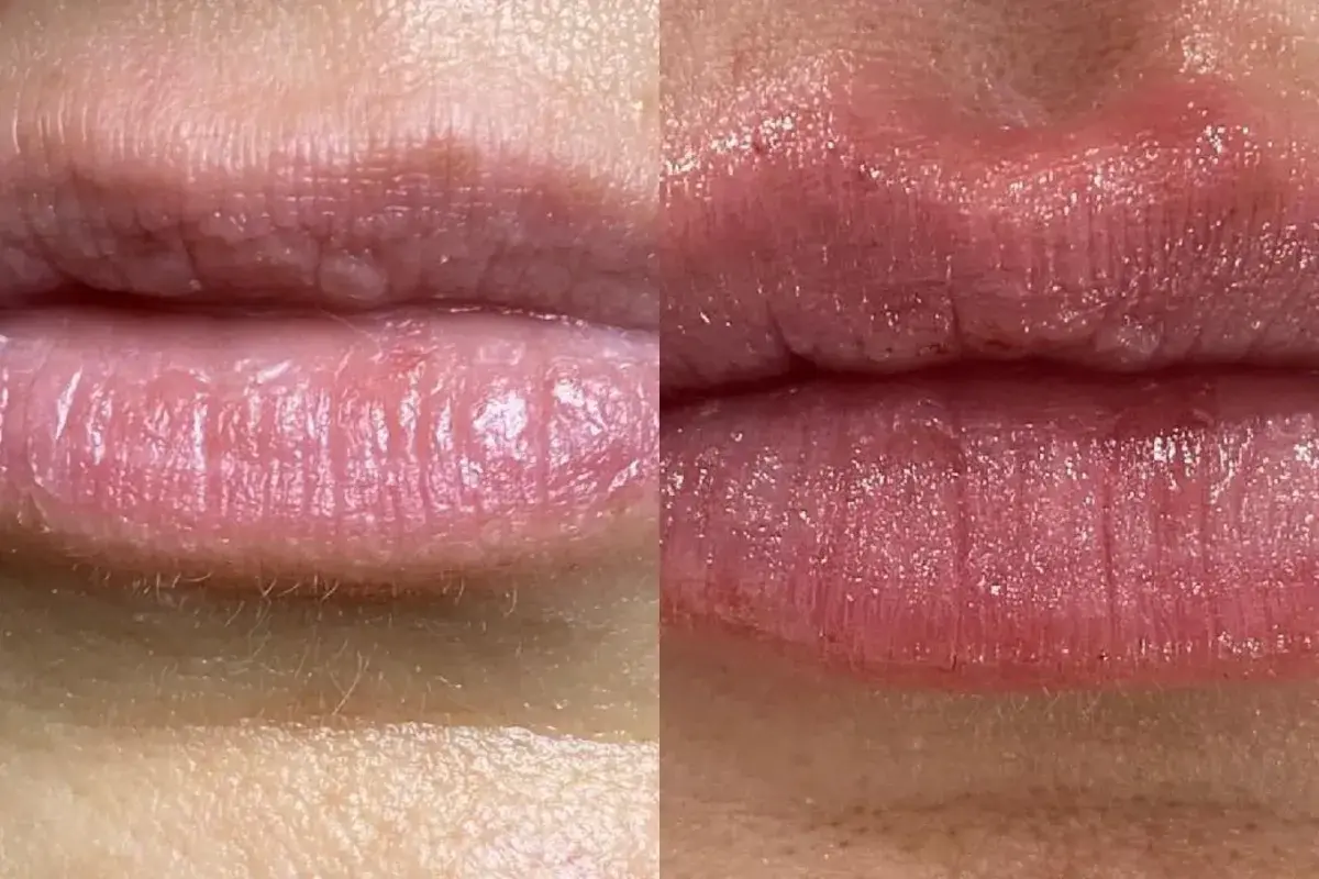 Cosmetica Med Spa lip filler result — Boca Raton, FL