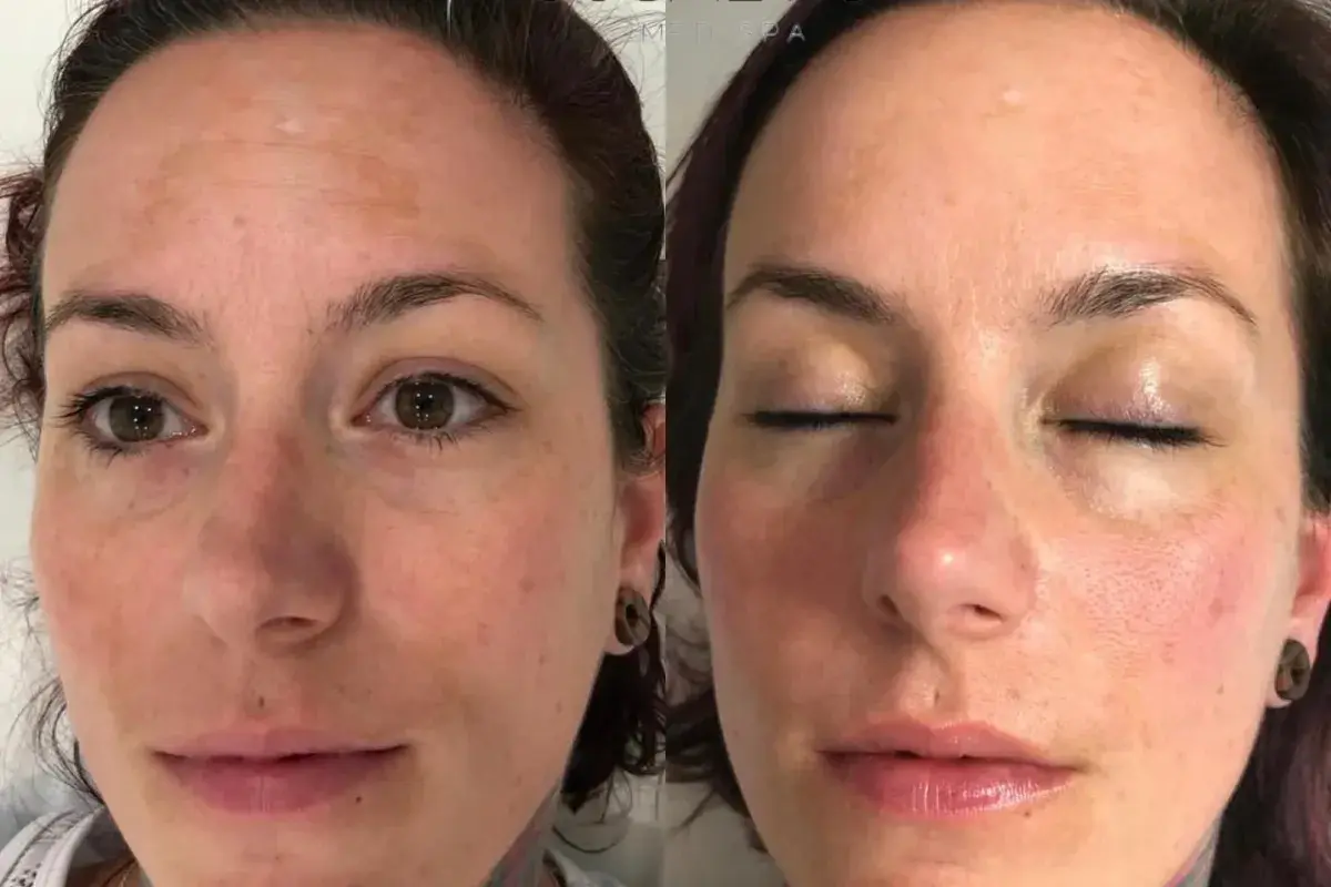 Cosmetica Med Spa microneedling result — Boca Raton, FL