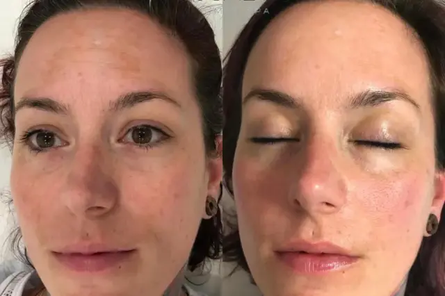 Microneedling result at Cosmetica Med Spa in Boca Raton, FL