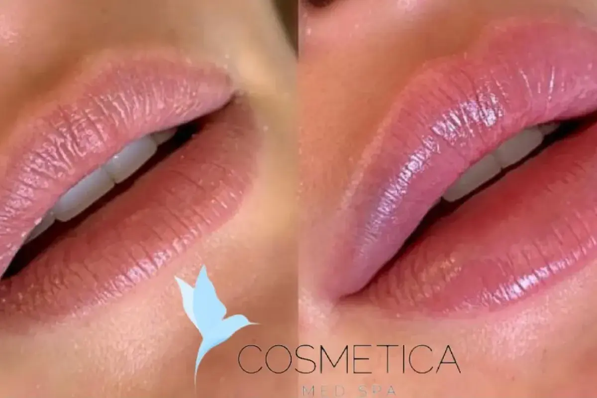 Cosmetica Med Spa lip filler result — Boca Raton, FL