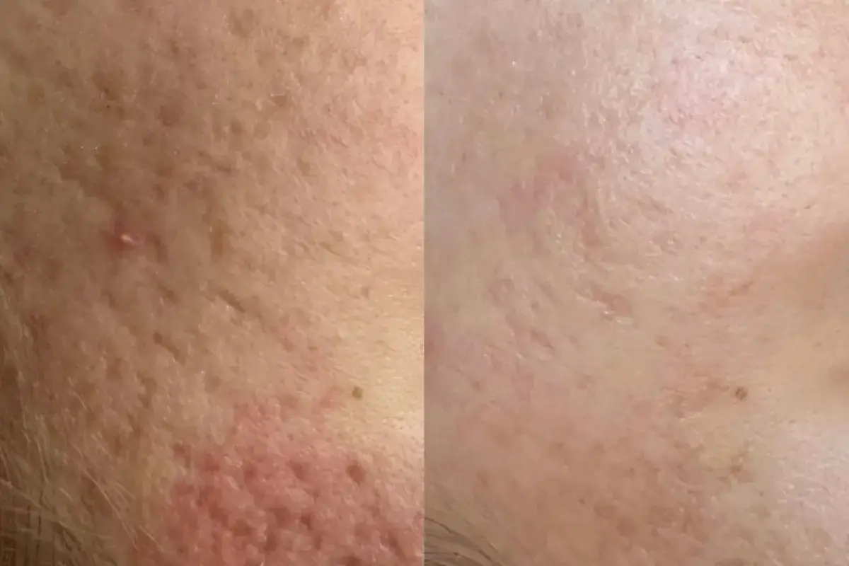 Cosmetica Med Spa microneedling result — Boca Raton, FL