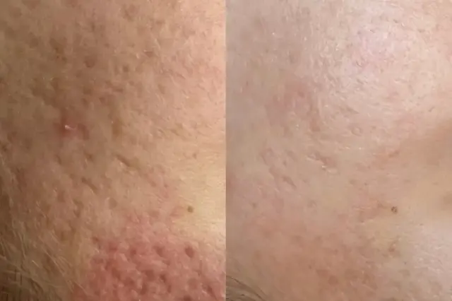 Microneedling result at Cosmetica Med Spa in Boca Raton, FL