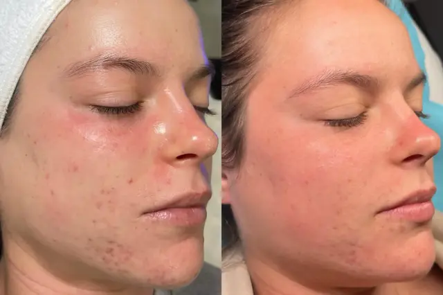 Chemical Peel result at Cosmetica Med Spa in Boca Raton, FL