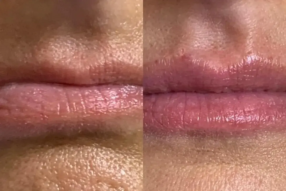 Cosmetica Med Spa lip filler result — Boca Raton, FL