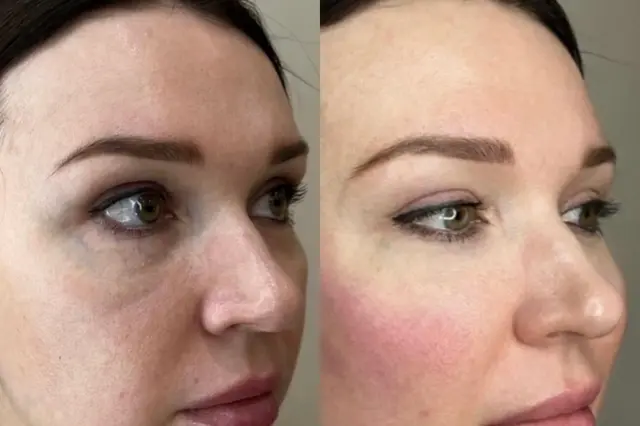 Juvederm result at Cosmetica Med Spa in Boca Raton, FL