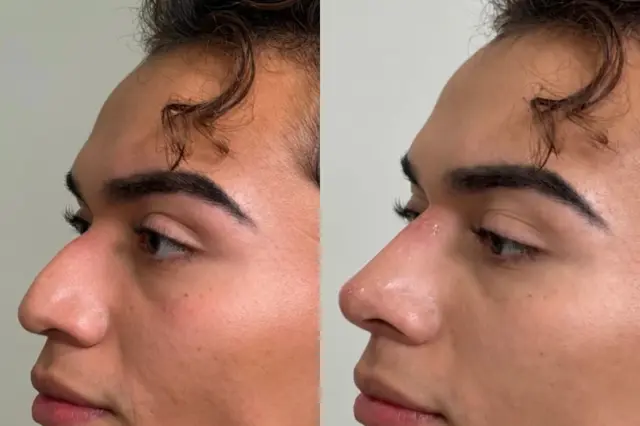 Liquid Rhinoplasty result at Cosmetica Med Spa in Boca Raton, FL