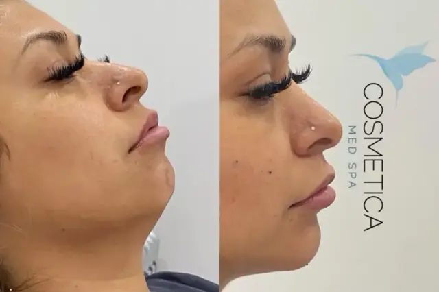Jawline Filler result at Cosmetica Med Spa in Boca Raton, FL