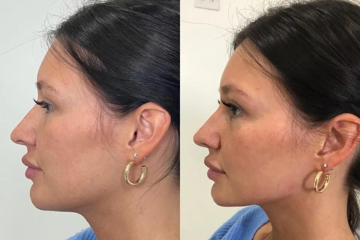 Cosmetica Med Spa jawline filler result — Boca Raton, FL