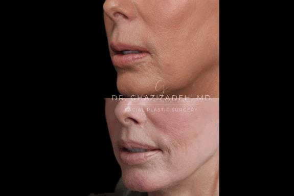 Dr. Shabnam Ghazizadeh MD, Facial Plastic Surgery lip lift result — Newport Beach, CA