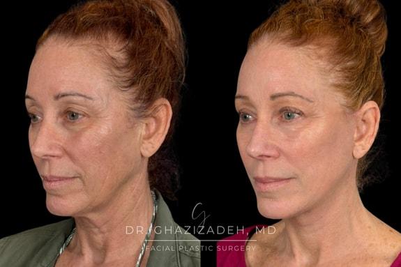 Dr. Shabnam Ghazizadeh MD, Facial Plastic Surgery facelift result — Newport Beach, CA