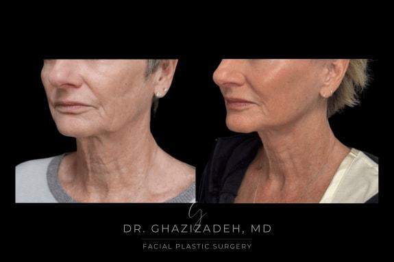 Dr. Shabnam Ghazizadeh MD, Facial Plastic Surgery facelift result — Newport Beach, CA