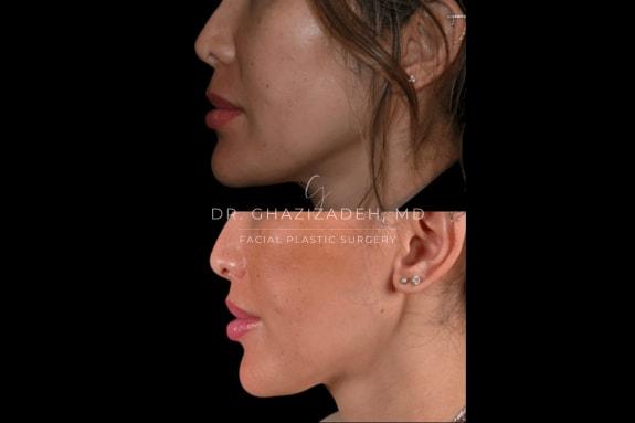 Dr. Shabnam Ghazizadeh MD, Facial Plastic Surgery lip lift result — Newport Beach, CA