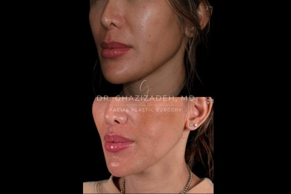 Dr. Shabnam Ghazizadeh MD, Facial Plastic Surgery lip lift result — Newport Beach, CA