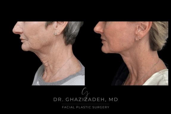 Dr. Shabnam Ghazizadeh MD, Facial Plastic Surgery facelift result — Newport Beach, CA