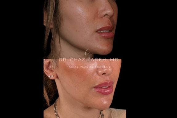 Dr. Shabnam Ghazizadeh MD, Facial Plastic Surgery lip lift result — Newport Beach, CA