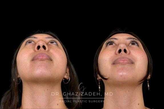 Rhinoplasty result at Dr. Shabnam Ghazizadeh MD, Facial Plastic Surgery in Newport Beach, CA
