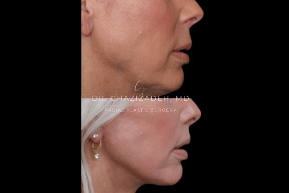 Dr. Shabnam Ghazizadeh MD, Facial Plastic Surgery lip lift result — Newport Beach, CA