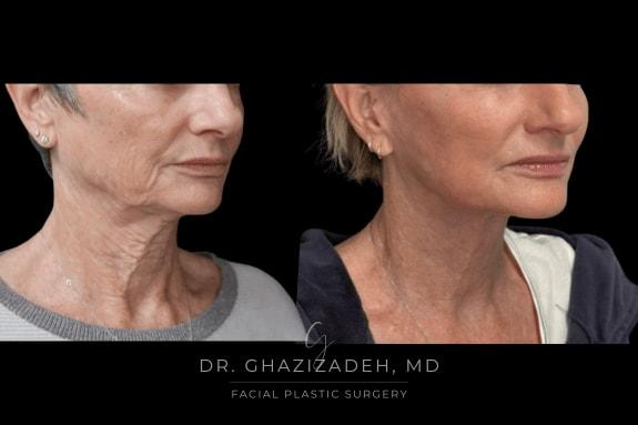 Dr. Shabnam Ghazizadeh MD, Facial Plastic Surgery facelift result — Newport Beach, CA