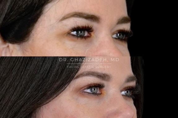 Blepharoplasty result at Dr. Shabnam Ghazizadeh MD, Facial Plastic Surgery in Newport Beach, CA