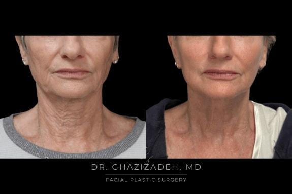 Dr. Shabnam Ghazizadeh MD, Facial Plastic Surgery facelift result — Newport Beach, CA