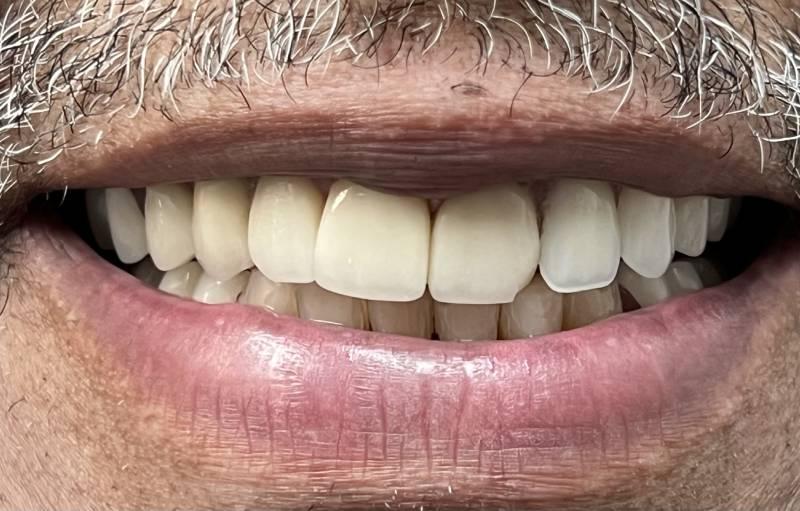 Smile Worth Dental Co. smile makeover after — Fort Worth, TX