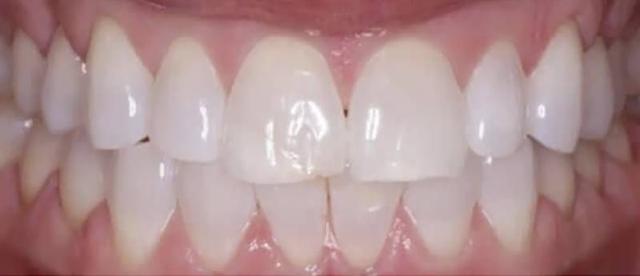 Smile Makeover before at Smile Worth Dental Co. in Fort Worth, TX
