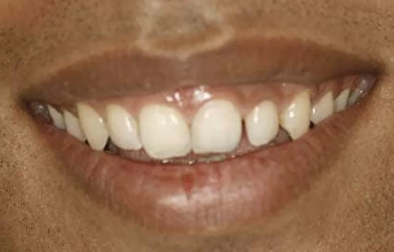 Smile Worth Dental Co. smile makeover after — Fort Worth, TX