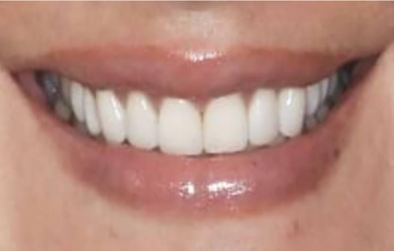 Smile Worth Dental Co. smile makeover after — Fort Worth, TX