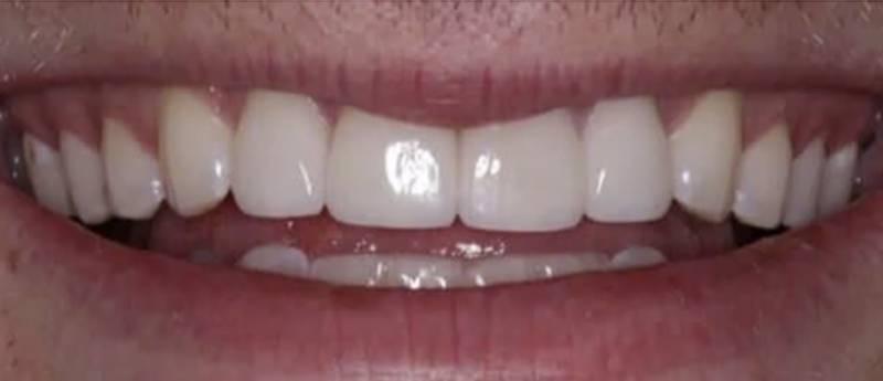 Smile Worth Dental Co. smile makeover after — Fort Worth, TX