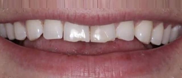 Smile Makeover before at Smile Worth Dental Co. in Fort Worth, TX