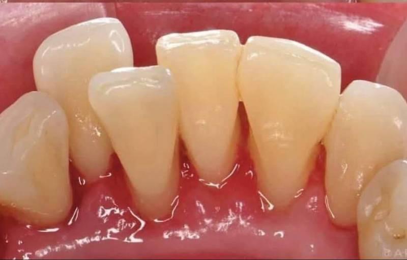 Smile Worth Dental Co. smile makeover after — Fort Worth, TX