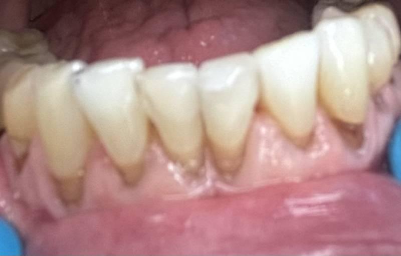 Smile Worth Dental Co. smile makeover after — Fort Worth, TX