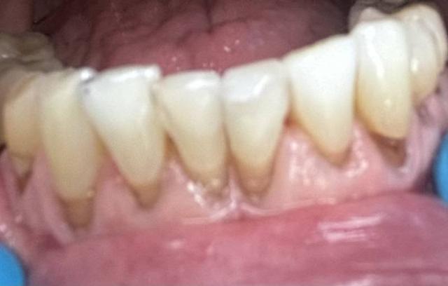 Smile Makeover after at Smile Worth Dental Co. in Fort Worth, TX